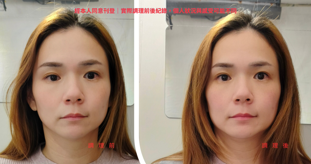 左右臉不對稱與大小臉平衡調理前後實際對照照片